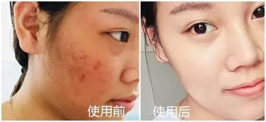 皮膚科醫生力薦 醫用面膜如何一招擺脫敏感肌困擾？