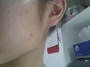 【我改善痤瘡經驗和須知你，從起步進階肌膚穩軌跡走出階段對望轉變安全】